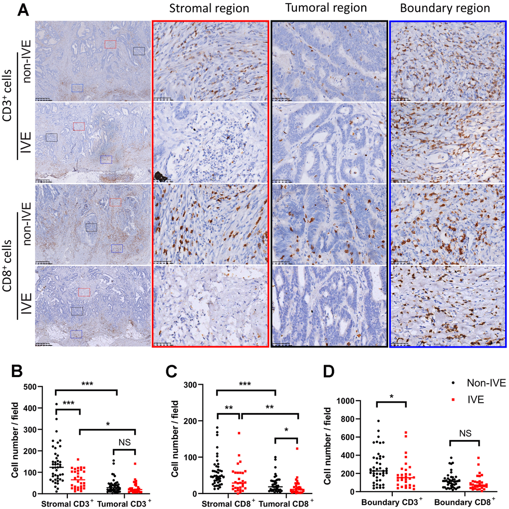 CRC with IVE had fewer CD3+ and CD8+ TILs. (A) representative images of CD3+ and CD8+ TILs in different regions of tumors with or without IVE. Stromal, tumoral, and boundary regions are indicated by red, black and blue rectangles, respectively. (B) tumor with IVE had fewer stromal CD3+ TILs compared with non-IVE. (C) tumors with IVE had fewer stromal and tumoral CD8+ TILs compared with non-IVE. (D) tumors with IVE had fewer boundary CD3+ TILs but similar CD3+ TILs. (NS, P > 0.05; *, P P P 