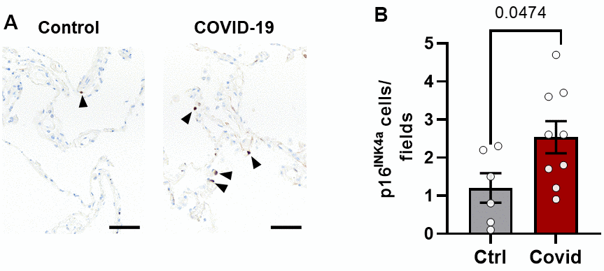 Lung p16INK4a+ senescent cell burden is greater in patients dying from acute SARS-CoV-2 than other causes. Lung tissue from patients who died from SARS-CoV-2 (n=9) were compared to controls (n=6) who died from other causes without lung disease (see Supplementary Tables 2, 3). (A) Paraffin-embedded lung autopsy tissue was sectioned and stained for p16INK4a by immunohistochemistry (black arrowheads). (B) Fifteen fields of alveolar tissue were randomly selected and counted. Mean +/- SEM, unpaired 2-tailed Student’s t-test.