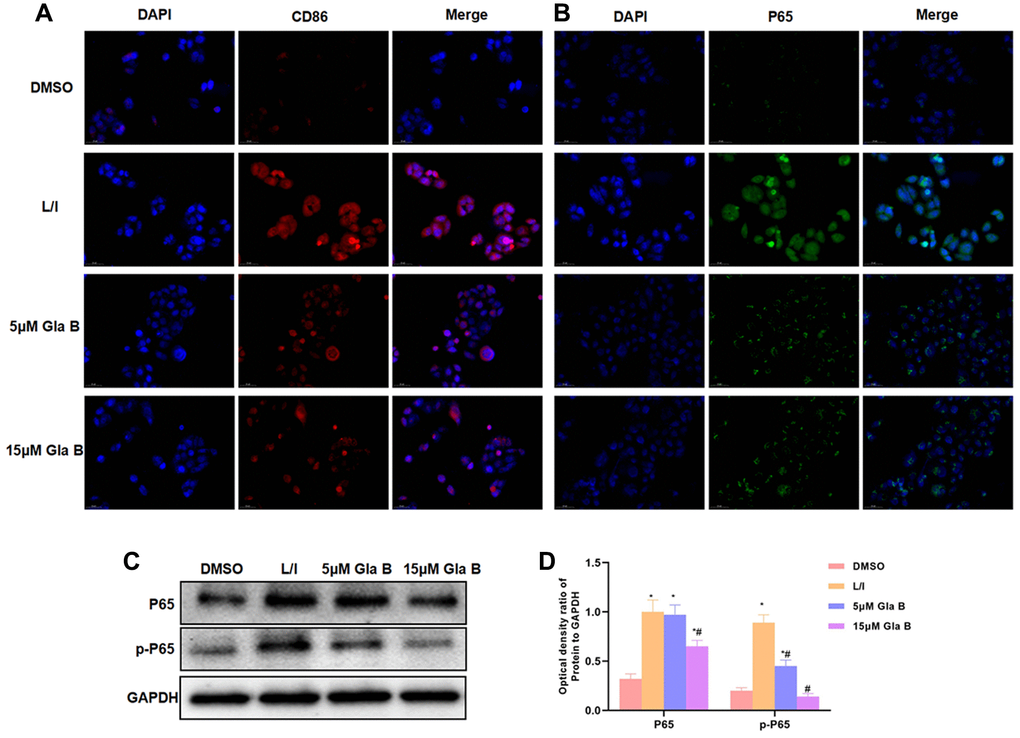 The effect of Glaucocalyxin B on the expression of CD86 and P65. (A–B) IF staining of CD86 and P65 showed that the levels of CD86 and P65 were significantly up-regulated in M1 SMG, which were higher than DMSO. Gla B could inhibit the expression of P65 and CD86. (C–D) Western-Blot (n = 3), the levels of P65 and p-P65 were significantly up-regulated in M1 SMM, which were higher than DMSO. Gla B could inhibit the expression of p-P65 and P65. Comparison with DMSO, *P #P 