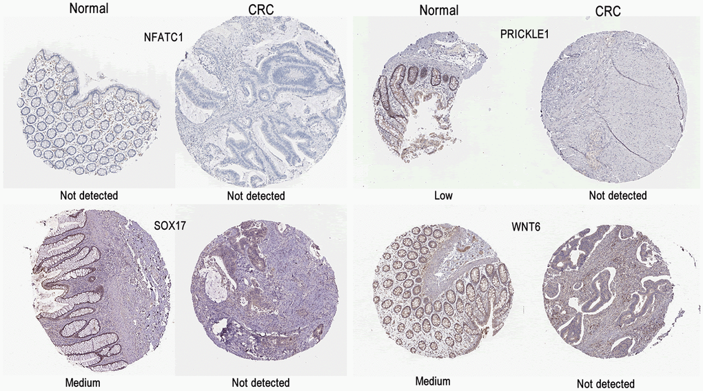 Validation of the mRNA expression levels of NFATC1, PRICKLE1, SOX17, and WNT6 in READ tissues and normal rectal tissues using GEPIA. The red box represents READ samples (92), and the gray box represents normal samples (318). READ, rectal adenocarcinoma. Significance markers: ***, p