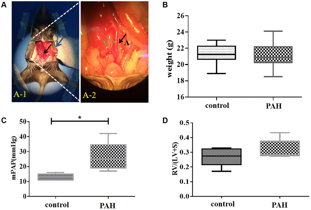 Shunt-associated pulmonary artery hypertension (PAH) model was established and evaluated in mice with abdominal shunt. (A) A pulmonary artery hypertension (PAH) mouse model was generated by the abdominal shunt technique. (A-1), a mouse was shown for undergoing the surgery to create a shunt-associated pulmonary artery hypertension (PAH) mouse model. The intestine of the mouse intestinal tube (blue arrow) was pushed aside to allow the abdominal aorta (black arrow) and inferior vena cava (thin green arrow) to be exposed for operation. (A-2), a magnified image of the surgical site in (A-1) for the operation to induce the pulmonary artery hypertension. After surgery, red blood flowed past the proximal heart end of the inferior vena cava (V, thin green arrow), indicating the success of the surgery. Black arrow, abdominal aorta (A). (B) There was not much change in the average mouse weight in the PAH model group compared with that in the control group when they were measured in about 8 weeks after the surgery. (C) The pulmonary artery pressure was increased in the PAH mice compared with the control mice when they were examined in 8 weeks after surgery. (D) Right ventricular hypertrophy index (RVHI) was measured and compared between the PAH mice and the controls in 8 weeks after surgery. *P 