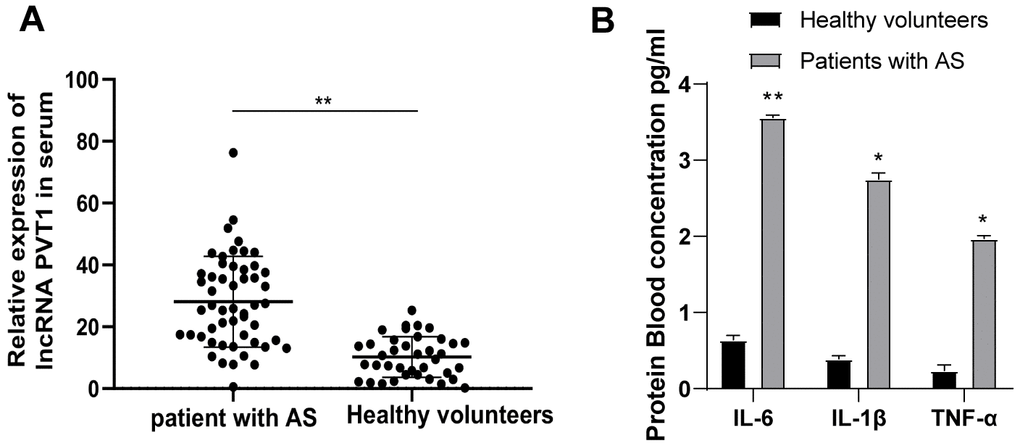 PVT1 is highly expressed in AS patients. (A) Relative PVT1 expression in serum of AS patients and healthy controls detected by qRT-PCR; (B) Levels of IL-6, IL-1β and TNF-α in serum of AS patients detected by ELISA. * p  0.05, ** p  0.01. PVT1, plasmacytoma variant translocation 1; AS, atherosclerosis; CRP, C-reactive protein; IL, interleukin; TNF-α, tumor necrosis factor-alpha.