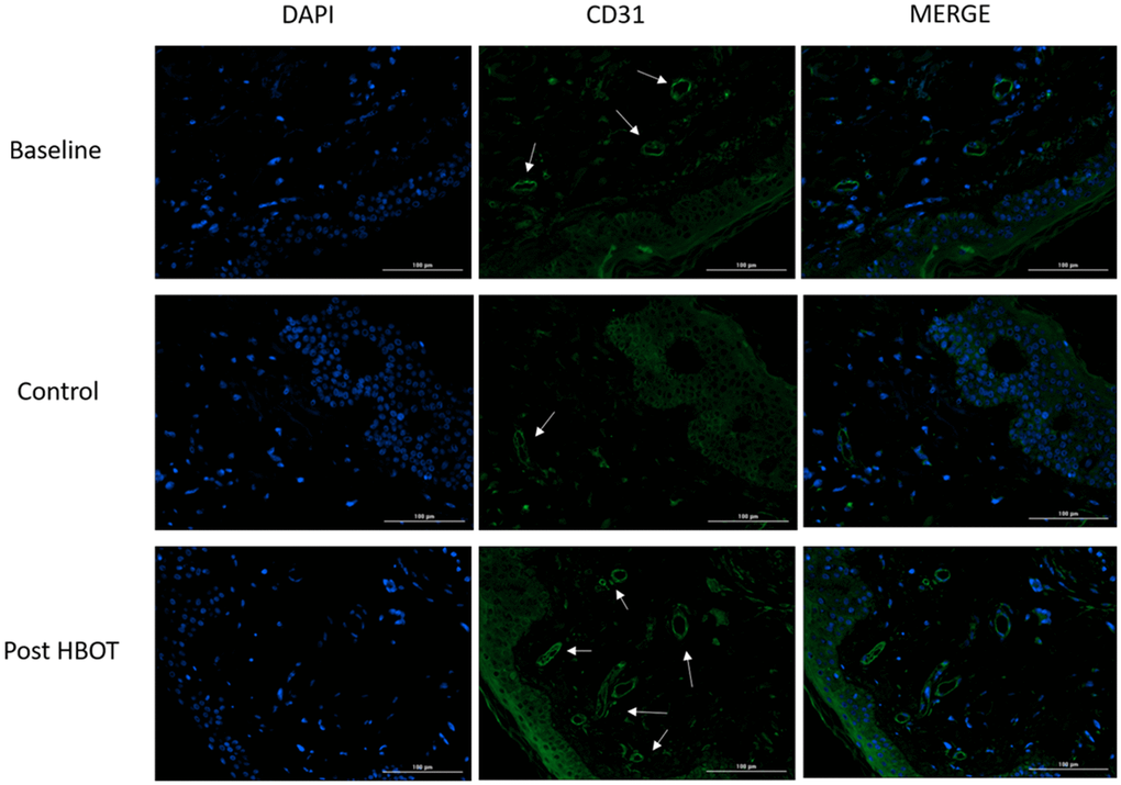 Blood vessels changes. Following HBOT, there was a significant increase in tissue blood vessels. Left column: DAPI staining for intact cells evaluation; middle column: CD31 staining of endothelial cells; right column: merging of DAPI and CD31.