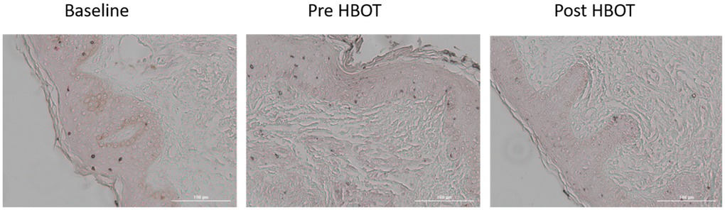 Senescence cells changes. Following HBOT, there was a significant decrease in number of tissue senescent cells.