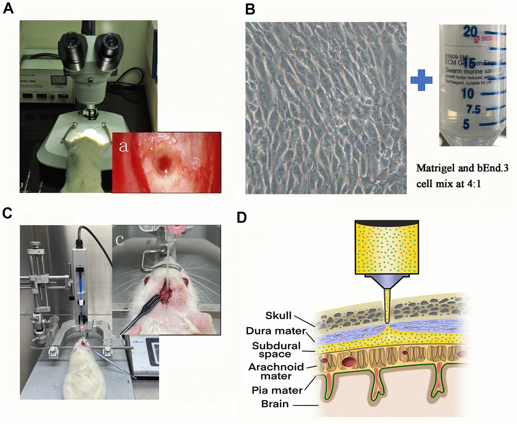 Illustration of the rat model of CSDH. (A) The sphenoid burr hole was made using a modified drill, and the dura was punctured under a microscope. (a) The microscopic photograph of the burr hole. (B) Prepare the cell-matrix glue mixture for injection. Representative photomicrograph of the morphology of bEnd.3 cells under light microscope and Sigma-Aldrich Matrigel. (C) A photograph of the entire assembly comprised of a stereotaxic frame and a stereotaxic injector with a 20-gauge catheter. (c) Zooming diagram of model rat. (D) Schematic diagram of drilled sphenoid burr hole, punctured dural hole, and catheter perfusion.