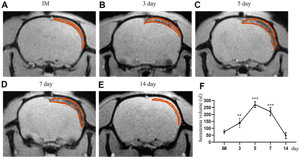 The dynamic change in hematoma volume in the chronic subdural hematoma model. (A) The MRI (GRE sequence) in the IM group. The part circled in red is the mixture of Matrigel and cells located in the subdural cavity of the rat; at this time, there is no blood signal in the subdural cavity. (B–E) Dynamic MRI (GRE) on the 3rd, 5th, 7th and 14th days after the establishment of the model. The part circled in red is the hematoma formed by spontaneous hemorrhage in the subdural region, in which the thickness and volume of the hematoma peaked at 5 d post-injury. At 14 d, most of the hematoma had been absorbed. (F) The dynamic change in the hematoma volume of the rats after modeling. IM: immediately after modeling. ** indicates p 