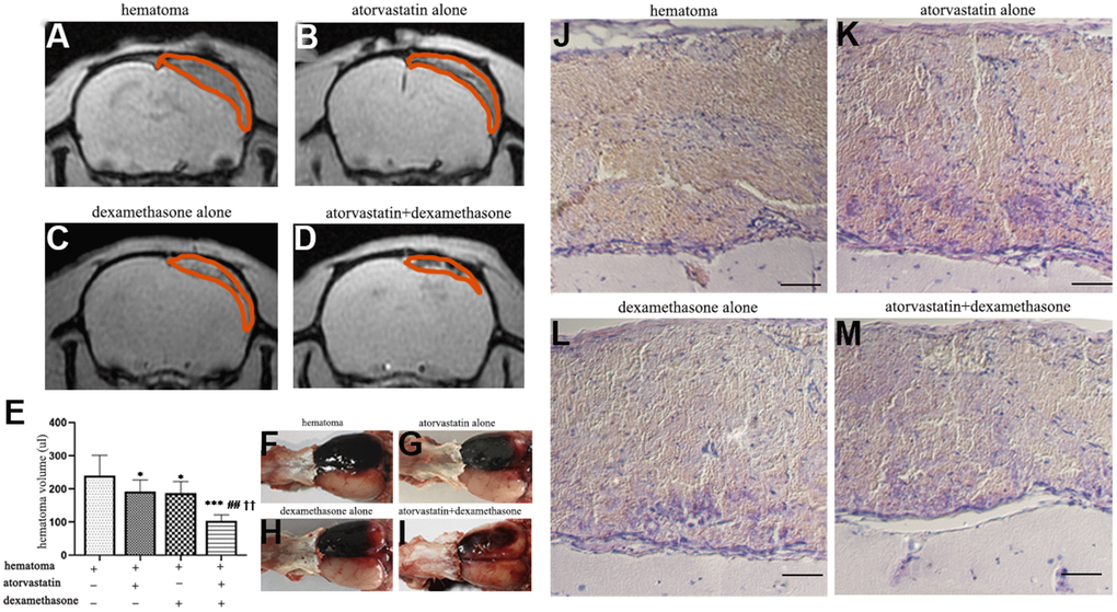 MRI and HE staining showed hematoma volume changes in different intervention groups on the 5th day after modeling. (A) Representative MRI (GRE) images of hematomas on the 5th day in the hematoma group. (B, C) Representative MRI (GRE) images of hematomas on the 5th day after treatment with atorvastatin and dexamethasone separately. (D) Representative MRI (GRE) images of hematomas on the 5th day in the atorvastatin + dexamethasone treatment group. (E) The changes in hematoma volume of the rats with CSDH after different treatments. (F–I) Typical images of growth appearances in different treatment groups after hematoma injury. (J–M) Representative H&E staining in different treatment groups after hematoma injury, bar =100 μm. * p 