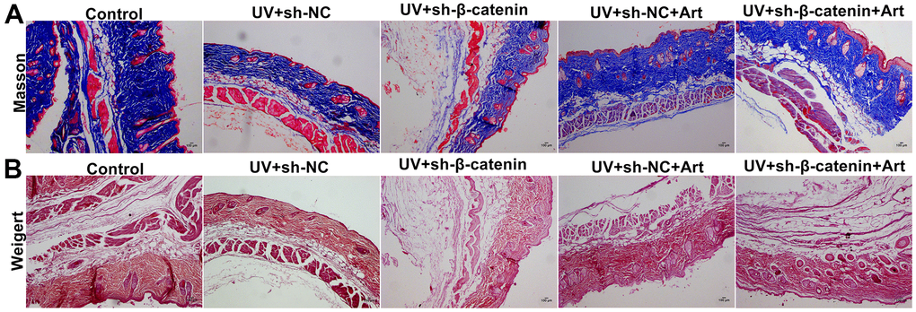 The effects of Art treatment and silencing β-catenin expression on UV irradiation-induced collagen fiber and elastic fiber damage in skin tissues. (A) Masson staining of skin tissues in each group. Control group: collagen was rich, neatly arranged without thickening or breakage; UV + sh-NC group: collagen was less and the arrangement was disordered; UV + sh-β-catenin group: there was a significant decrease in collagen and disordered arrangement; UV + sh-NC + Art group: collagen was increased, and the arrangement gradually became regular; UV + sh-β-catenin + Art group: collagen was increased slightly, but it was still thick, broken, and curled. Magnification: 100×. (B) Weigert staining of skin tissues in each group. Control group: elastic fibers were neat; UV + sh-NC group: some elastic fibers were broken, abnormally proliferating, crimping, bifurcation, and interweaving; UV + sh-β-catenin group: elastic fibers were significantly damaged; UV + sh-NC + Art group: elastic fiber arrangement gradually became regular; UV + sh-β-catenin + Art group: elastic fiber arrangement was slightly ameliorated. Scale bar: 100 μm. Magnification: 100×.