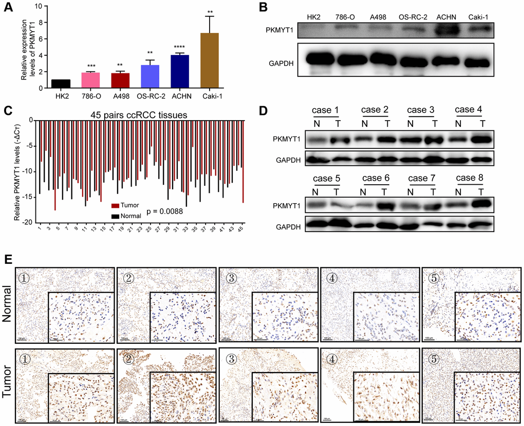 Overexpression of PKMYT1 in renal cancer cells and tissues. The expression of PKMYT1 in renal cancer cells was measured using real-time quantitative reverse transcription-PCR (A) and western blotting assays (B). The expression of PKMYT1 in renal cancer tissues and paired normal tissues was measured using real-time quantitative reverse transcription-PCR (C), western blotting assays (D) and immunohistochemistry (E). Data are presented as the mean ± standard deviation of three independent experiments, and were compared to HK-2 cells. **P ***P ****P 