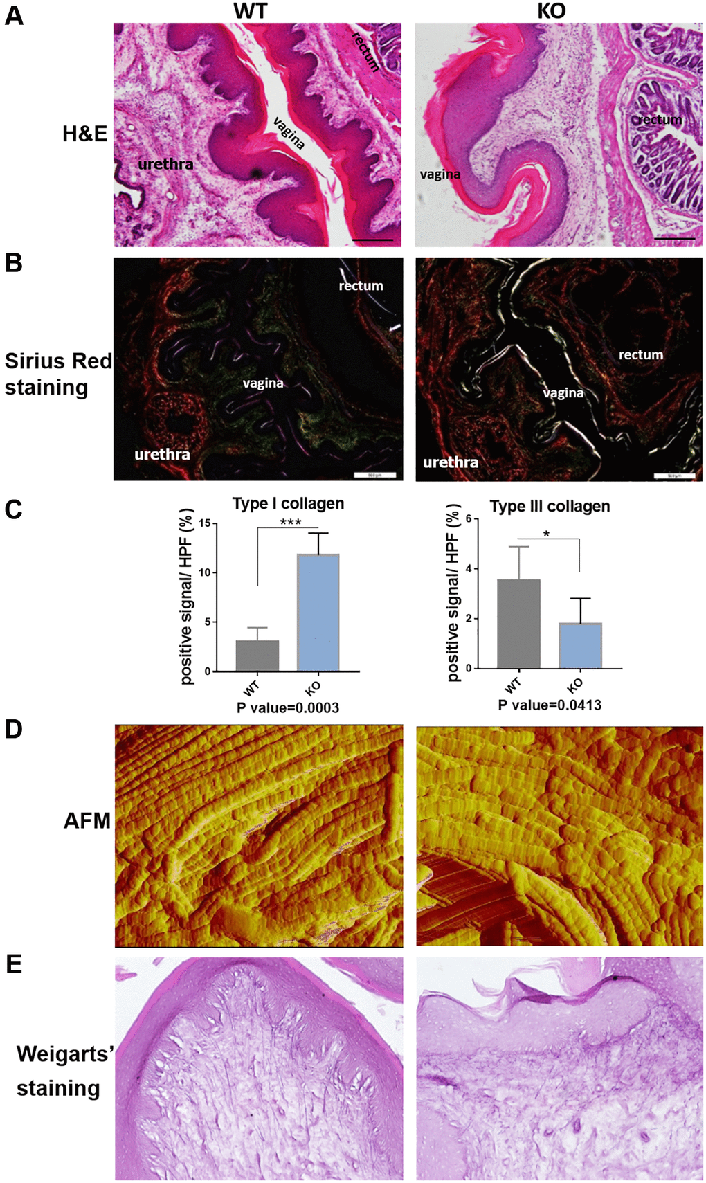 Loxl1 knockout mice reproduce the micro-structural changes of clinical POP. (A) HE staining showed obvious microstructure space and disappeared Vicious Angle structure in Loxl1 knockout mice, scale bar 100 um. (B) Sirius red staining demonstrated increased type I collagen and decreased type III collagen in Loxl1 knockout mice, scale bar 100 um. (C) Sirius red staining as in B was quantified, the proportion of positive signals area (red signals for type I collage and green signals for type III collagen) in each High Power Field of vision (HPF) were quantified, n = 4 in each group. (D) Atom force microscope (AFM) showed aligned collagen fibers in WT mice while disordered arranged collagen fibers in Loxl1 knockout mice. (E) Weigarts’ staining of the vagina tissue showed the elastic fibers in WT mice were linear and polarized, while in the knockout mice were fragmented and arranged disordered.