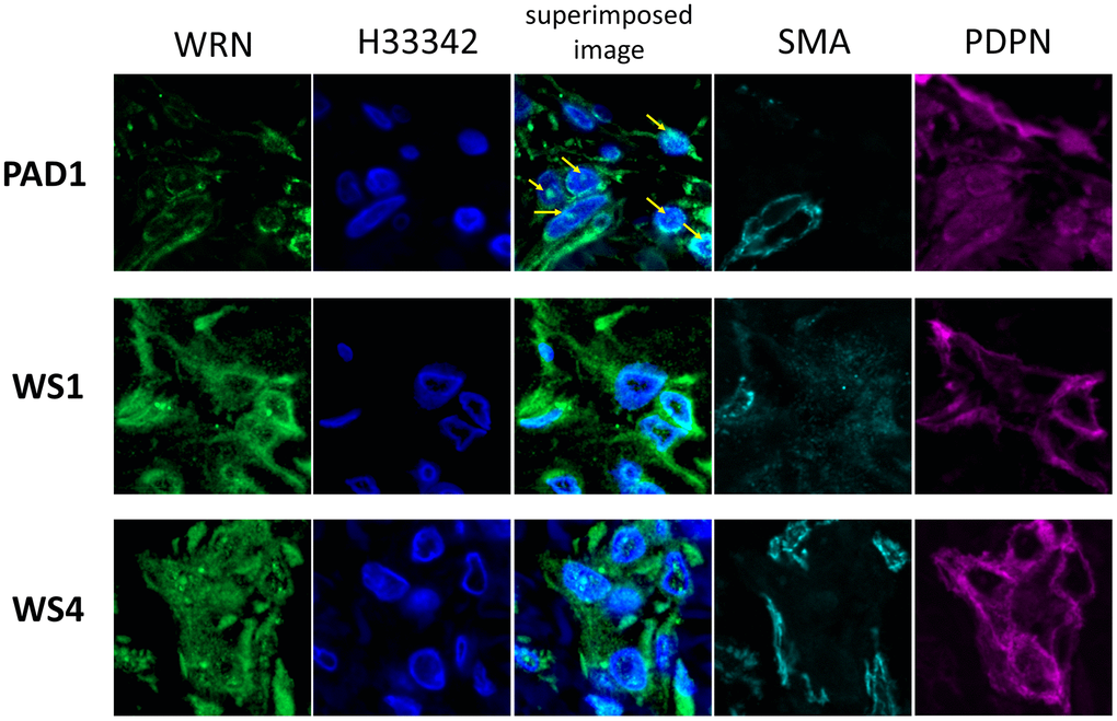 Immunofluorescent staining images of lymphatic vessels of the patient's skin. Immunofluorescent staining images of lymphatic vessels in the dermis of two patients with WS and one with PAD are shown. A stained image with WRN antibody, Hoechst 33342, superimposed image, αSMA antibody, and podoplanin antibody are shown on the left. Samples collected from PAD1, WS1, and WS4 are shown at the top. In PAD1, the WRN protein is localized in the nucleus (arrow), whereas in WS1 and WS4, it is spread throughout the cytoplasm.