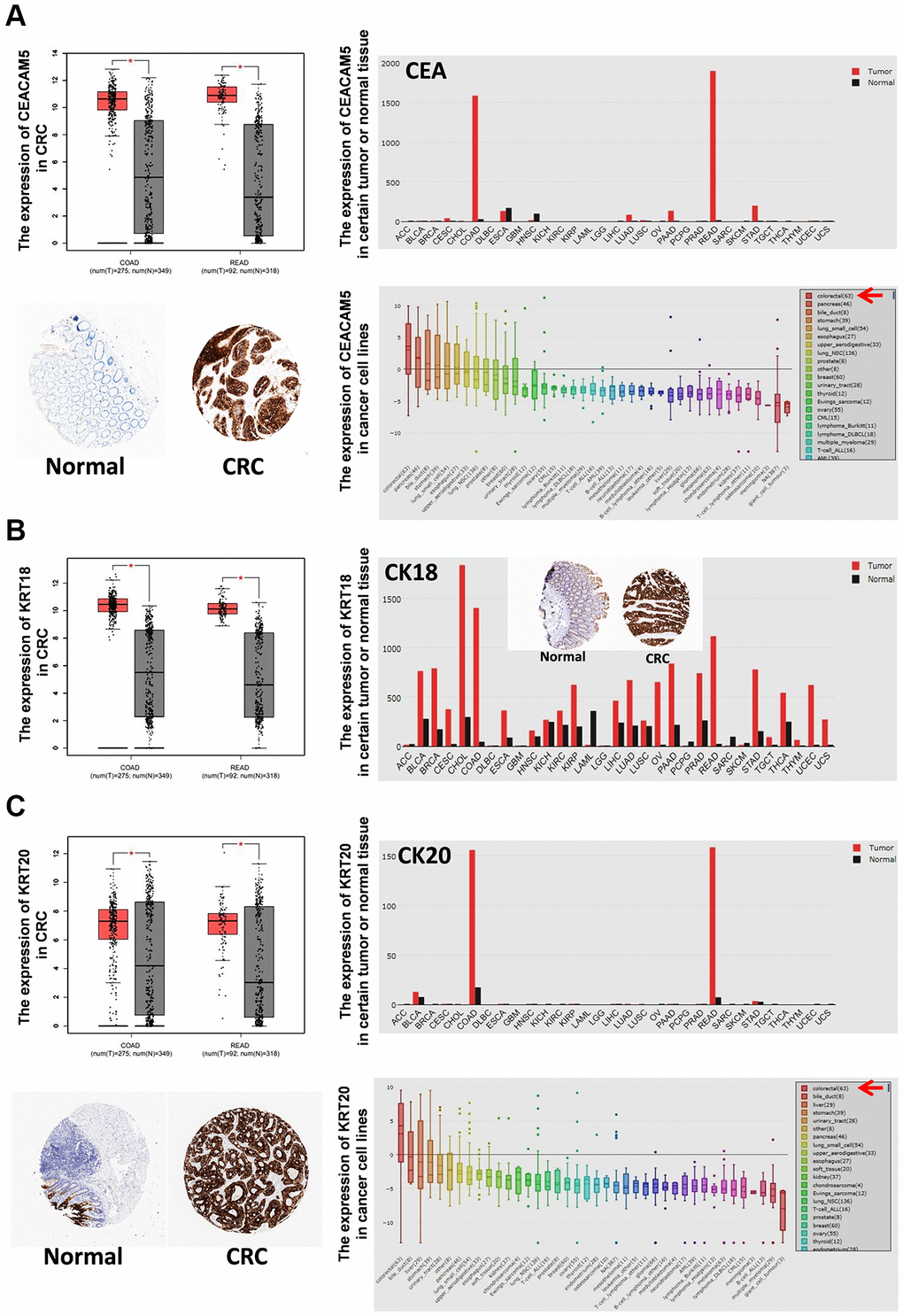 The expression of CEA, CK18 and CK20 in tumor tissues and cancer cell lines. The mRNA expression of CEA (A), CK18 (B) and CK20 (C) in certain tumor tissues and CRC tissues was analyzed by GEPIA. The protein expression of CEA (A), CK18 (B) and CK20 (C) in CRC tissues was stained by immunohistochemistry (IHC) and analyzed by HPA. The mRNA expression of CEA (A), CK18 (B) and CK20 (C) in cancer cell lines was analyzed by CCLE. Abbreviations: COAD: colon adenocarcinoma; READ: rectum adenocarcinoma.