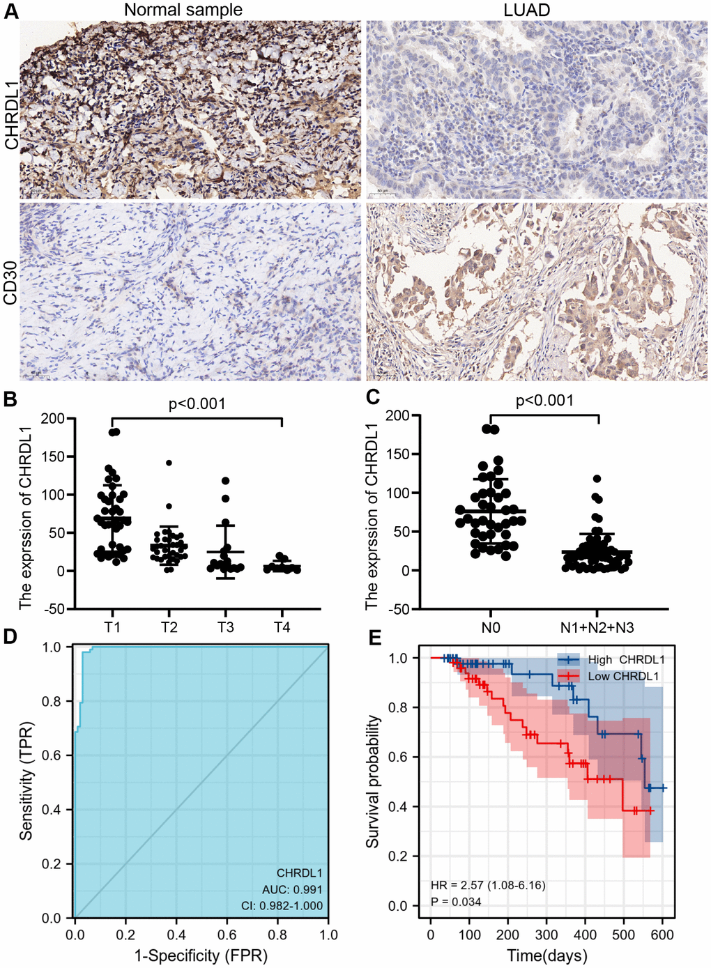 The experimental validation of CHRDL1 by IHC. (A) IHC staining of CHRDL1 and CD30 in normal sample and LUAD tissues. (B, C) Validation of association between CHRDL1 expression and TNM stage by IHC. (D) Validation of CHRDL1 expression showing discrimination power between normal samples and LUAD tissues by IHC. (E) Validation of the impact of CHRDL1 expression on overall survival in LUAD patients.