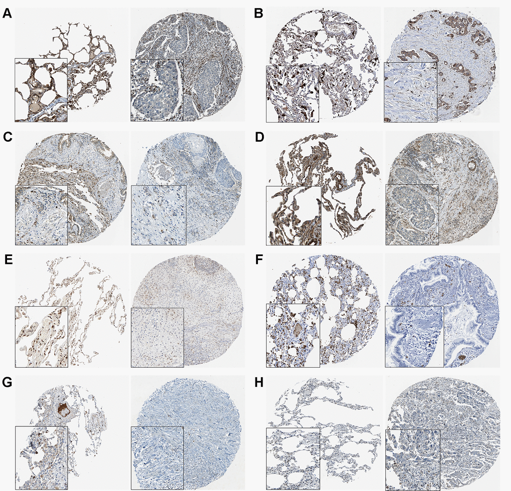 The THPA results of 8 target genes in normal and tumor tissues. (A) AMOTL2. (B) BCL2L2. (C) CACDH1. (D) MSRB3. (E) NFIB. (F) S1PR2. (G) SORT1. (H) SRF.