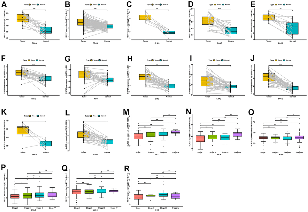 Expression of NUP37 in paired tumor and adjacent normal tissues and various tumor stages. (A–L) NUP37 expression in paired tumor and adjacent normal tissues from TCGA in indicated tumor types. (M–R) NUP37 expression in various tumor stages in indicated tumor types. *P 