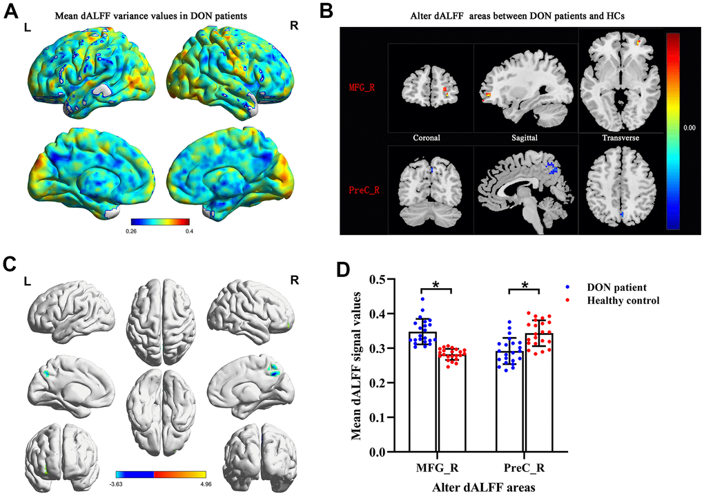 Comparison of different dALFF values between the DON patients and HCs. Spatial patterns of dALFF variance were observed in DON patients. The mean dALFF variance maps within DON patients (A). Compared with HCs, patients with DON showed increased MRG