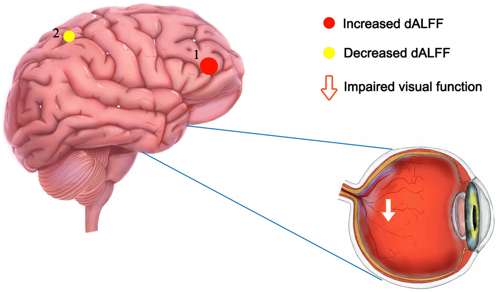 The mean dALFF values of altered cerebrum regions. Compared with HCs, the dALFF values of the following region 1 in DON patients was increased: MFG