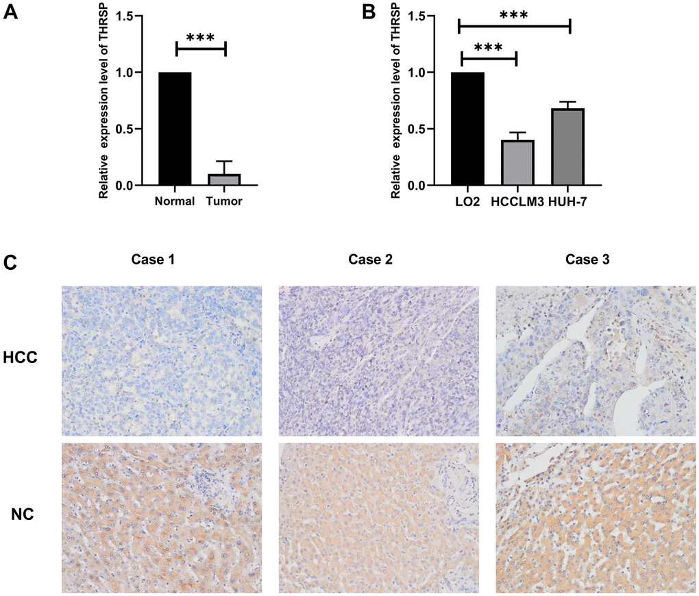 The expression of THRSP at mRNA and protein levels. (A, B) The mRNA expression of THRSP in HCC tissues and cells compared with control examined by RT-qPCR. (C) The protein expression of THRSP in HCC tissues and the adjacent normal tissues examined by immunohistochemical (200×).