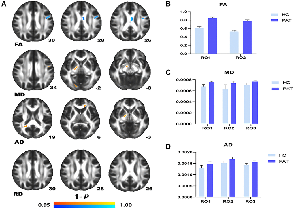 Comparison of DTI value of HC and PAT group. Mean DTI values between PAT and HC groups (A–C). (A) ROI1-left superior longitudinal fasciculus; ROI2-body of corpus callosum. (B) ROI1-left superior longitudinal fasciculus; ROI2-right posterior limb of internal capsule. ROI3-right posterior thalamic radiation. (C) ROI1-genu of corpus callosum; ROI2-right posterior limb of internal capsule; ROI3-right splenium of corpus callosum. Significant difference in mean DTI value between HC and PAT group. (D) The red area indicates that the value of PAT is higher than HC and blue areas indicate lower values. Abbreviations: FA: fractional anisotropy; MD: mean diffusivity; AD: axial diffusivity; HC: healthy controls; PAT: patient; ROI: region of interest.