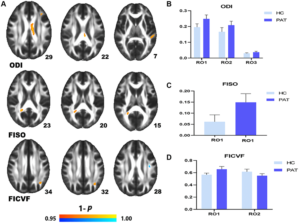 Comparison of NODDI value of HC and PAT group. Mean NODDI values between PAT and HC groups (A–C). (A) ROI1-left anterior corona radiata; ROI2-body of corpus callosum; ROI3-left superior longitudinal fasciculus. (B) Right splenium of corpus callosum. (C) ROI1-left posterior corona radiata; ROI2-left superior longitudinal fasciculus. Significant difference in mean NODDI value between HC and PAT group (D) The red area indicates that the value of PAT is higher than HC and blue areas indicate lower values. Abbreviations: ODI: orientation dispersion index; FISO: isotropic volume fraction; FICVF: intra-cellular volume fraction; HC: healthy controls; PAT: patient; ROI: region of interest.