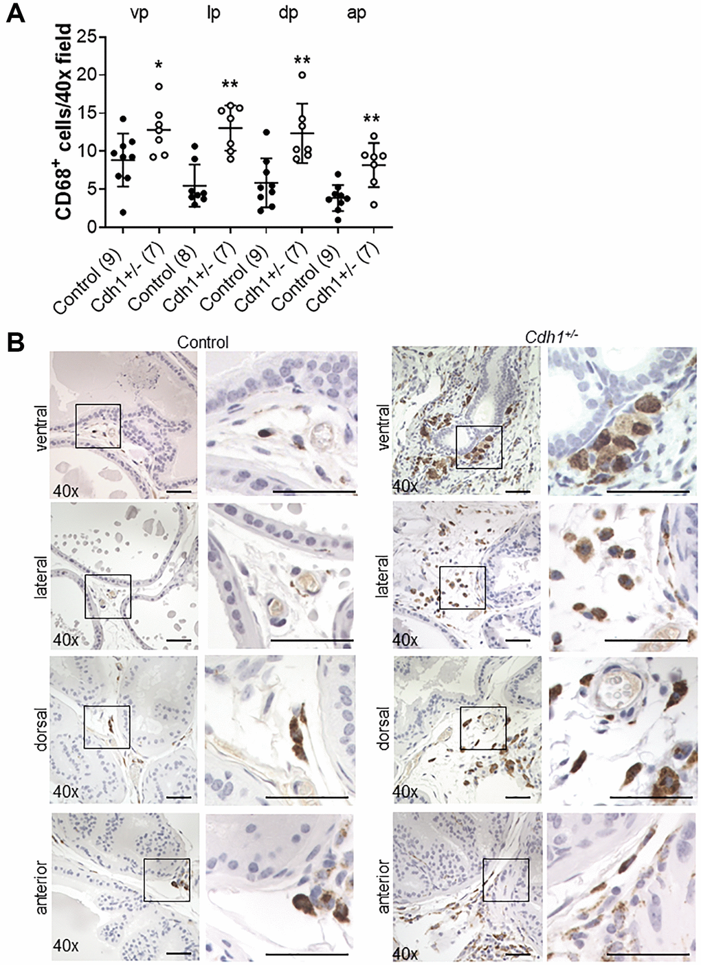 Impact of E-cadherin-deficiency on macrophage density in the murine prostate at 24 months of age. (A) Quantification of CD68+ macrophages in the prostate from Control and Cdh1+/- mice at 24 months of age. Abbreviations: vp: ventral prostate; lp: lateral prostate; dp: dorsal prostate; ap: anterior prostate. Data represent mean ± S.D, number of mice in each group in parentheses. Lobes which had been washed away during staining process were not quantified. (B) CD68 immunostaining (brown) in transverse sections of prostate ventral, lateral, dorsal, and anterior lobes from Control and Cdh1+/- mice at 24 months of age. Lobes which had been washed away during staining process were not quantified. Original magnification, 40×, inset 40×. *p **p 