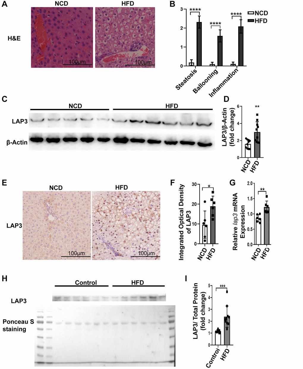 LAP3 was upregulated in 6-month HFD-induced E3 rats with NASH. (A) H&E staining of liver specimen for each animal group. (B) The score for hepatic steatosis, hepatocytes ballooning and lobular inflammation were analyzed (n = 10 per group). (C and D) The protein expression of LAP3 in livers of 6-month HFD induced NASH E3 rats were evaluated by Western blotting (C) and normalized by β-actin (D) (n = 11 for each group). (E) Increased LAP3 is predominantly expressed in hepatocyte nucleus in 6-month HFD induced NASH E3 rats through Immunohistochemistry (n = 10 per group). (F) Statistics for immunohistochemistry result by Image pro plus. (G) lap3 mRNA expression in livers of 6-month HFD induced NASH E3 rats was detected by RT-qPCR (n = 10 per group). (H and I) Serum LAP3 content in 6-month HFD induced NASH E3 rats was detected by western blotting (F) and normalized by serum total protein (G) (n = 10 per group). Data are expressed as means ± SD from three independent experiments. *p **p ***p 