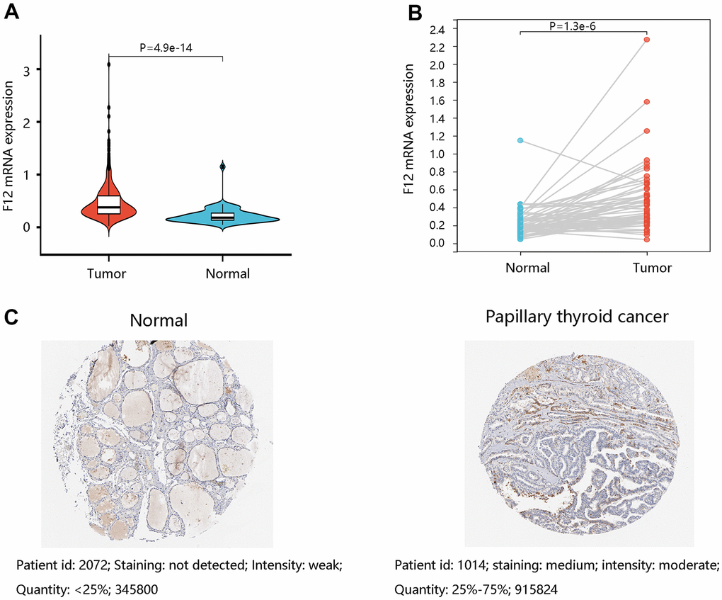 The expression levels of F12 in PTC. (A) The F12 mRNA expression in PTC and normal thyroid tissues. (B) The F12 mRNA expression in paired PTC samples. (C) The F12 protein expression in normal thyroid and PTC tissues. Image J software was used to quantify the protein levels of F12. PTC, papillary thyroid cancer.