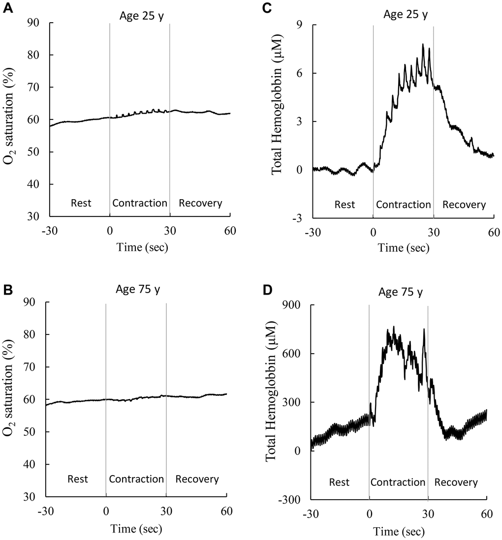 Representative cerebral hemodynamic response during a maximal handgrip strength test. BOV (amplitude or SD of oxyhemoglobin-to-total hemoglobin ratio) increases mildly during a 10-repeated maximal voluntary muscle exertion in adults aged 25 y (A) and 75 y (B). BHV (amplitude or SD of total hemoglobin) elevated substantially during the maximal contraction task in adults aged 25 y (C) and 75 y (D). To maintain stable oxygenation (A, B), the adult at age 75 y shows much vigorous cerebral hemodynamic response (scale increases ~100 folds) than the young counterpart at age 25 y, suggesting a huge compensatory cost of vascular control (vasoconstriction/ vasorelaxation) in the brain during muscle exertions. Abbreviations: SD: standard deviation of the 300 optical data in 30 sec; BOV: brain oxygenation variability; BHV: brain hemodynamic variability.