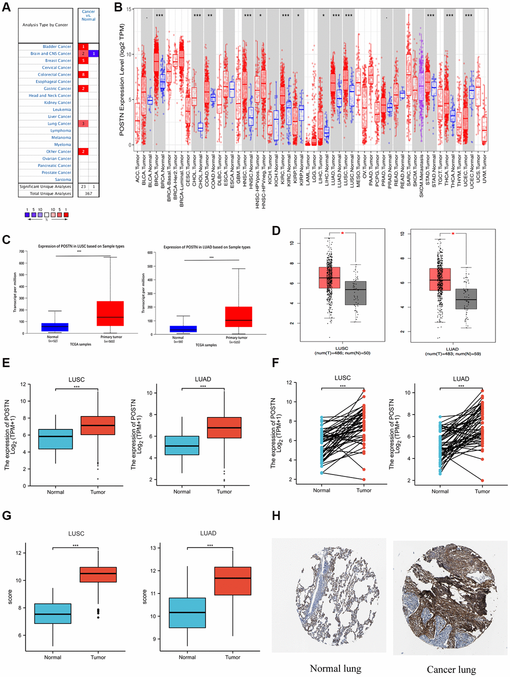 Expression of POSTN in lung cancer. POSTN expression in different cancers tissues compared to normal tissues based on the Oncomine database (A). POSTN expression in different tumour types based on the TIMER database (B). mRNA level of POSTN in lung cancer determined by UALCAN (C), GEPIA (D), and TCGA (E) databases. POSTN expression in 57 pairs of LUAD tissues and adjacent healthy tissues and 49 pairs of LUSC tissues and adjacent healthy tissues using TCGA database (F). POSTN expression in LUSC and LUAD based on the GEO database (G). The protein levels of POSTN based on the Human Protein Atlas (H). *p ***p 