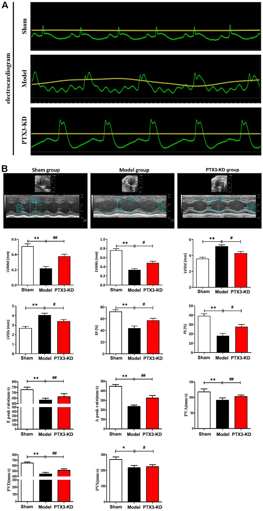 PTX3 KD improved the cardiac functions in murine HF after MI. (A) Electrocardiogram results confirmed that the animal model was successfully constructed. (B) Representative M-mode echocardiogram of LV in the parasternal short-axis view obtained from mice in each group. Echocardiographic parameters (LVAWd, LVAWs, LVIDd, LVIDs, ES and FS as well as E peak rate, A peak rate, PVA, PVD, PVS) at three cardiac cycles were recorded. LVAWd: left ventricular anterior wall thickness at end-diastolic; LVAWs: left ventricular anterior wall thickness at end-systolic; LVIDd: left ventricular internal diameter at end-diastolic; LVIDs: left ventricular internal diameter at end-systolic; EF: ejection fraction; FS: fraction shortening; PVD: Positive peak velocity of pulmonary vein in diastole; PVS: Peak systolic velocity of pulmonary vein; PVA: Negative peak velocity of pulmonary vein during atrial contraction. Control group vs. PTX3-NC group, *pp#p##p