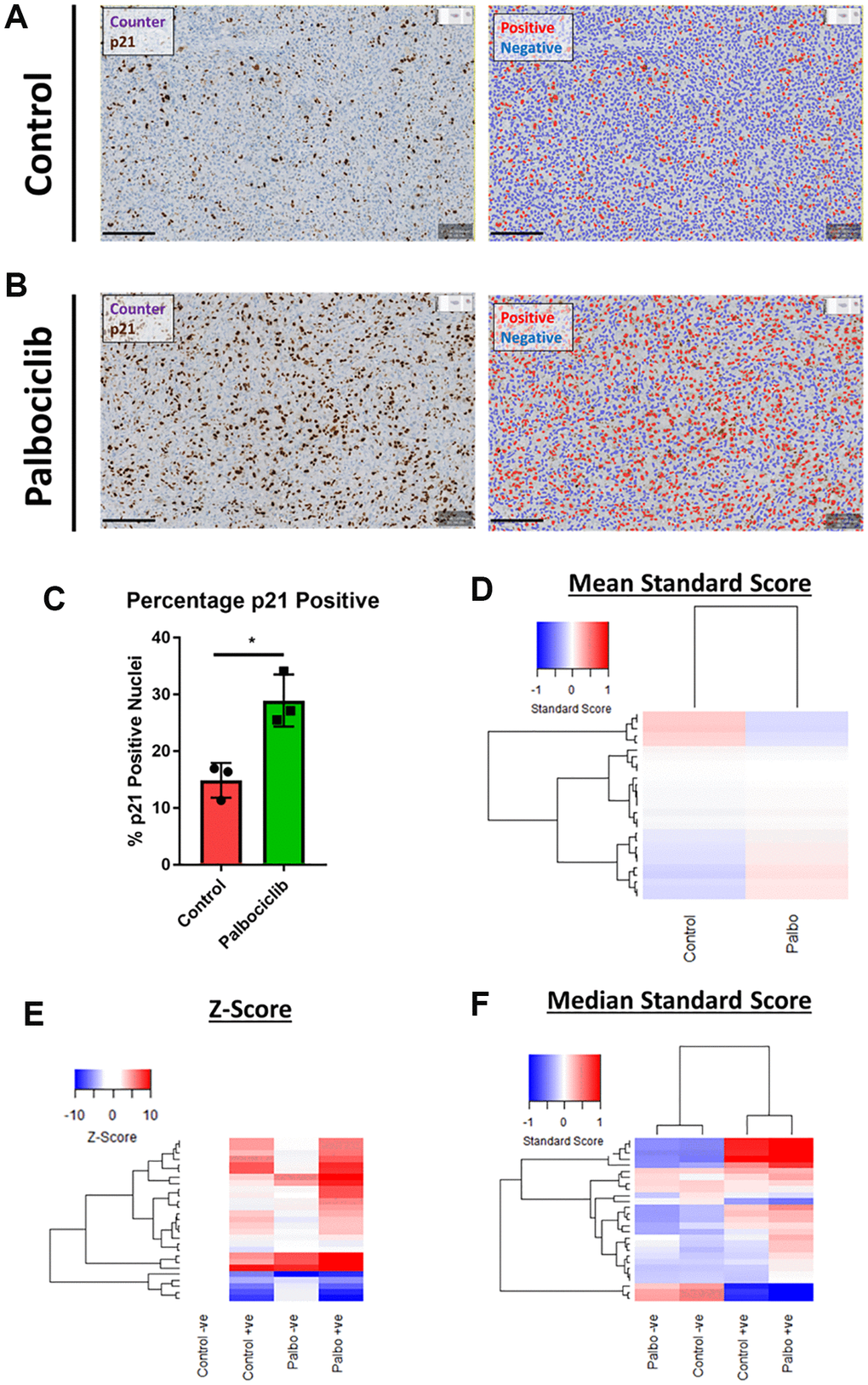 Assessment of senescence morphology in palbociclib treated human tumour xenografts. (A and B) Analysis mask generation to define p21 positive (red) and negative (blue) nuclei in control and palbociclib treated xenografts. Blue stain = Counterstain, Brown stain = p21. Scale bar = 200 μm. (C) Percentage p21 positivity of nuclei in control and palbociclib treated xenografts. (D) Mean standard score profiles of control and palbociclib samples. Y-axis comprises 27 morphological features (Red = positive modulation, Blue = negative modulation), White = no change). (E and F) Z-score and standard score profiles of p21 positive and negative cells in control and palbociclib treated xenografts. Y-axis comprises 27 morphological features (Red = positive modulation, Blue = negative modulation), White = no change). N = 3.