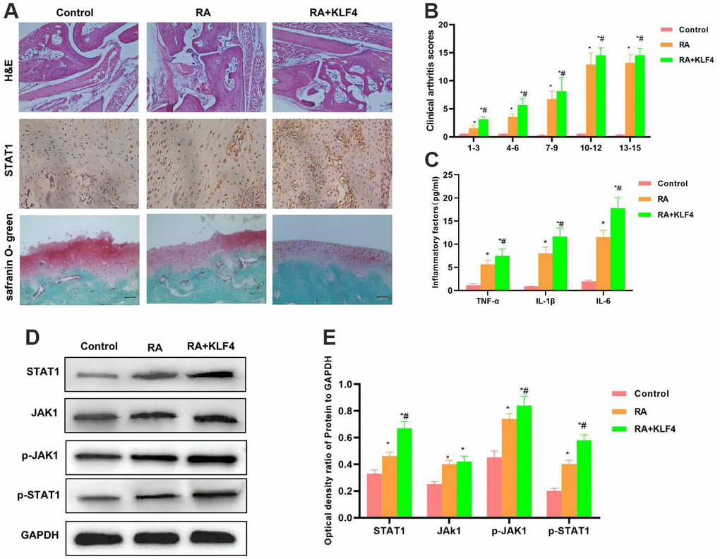 Effect of KLF4 on the pathology of RA mice (n=3). (A) In Cartilage surface and transitional layer, H&E staining of mouse joint tissues, IHC staining of STAT1 and Safranin O-fast green staining results (n=5). H&E staining results showed that, KLF4 further induced cartilage injury, and obvious joint tissue injury was observed in mice, which was more severe than that of RA group. KLF4 induced STAT1 expression in joint tissues, and the expression in RA+KLF4 group was markedly higher than that in RA group. Safranin O-fast green staining revealed diffuse staining in RA+KLF4 group, which suggested the more severe cartilage injury than that of RA group. (B) Mouse clinical pathological score (n=10). RA group had a remarkably higher score than Control group, and RA+KLF4 group had a markedly higher score than RA group. *P#PC) Expression of inflammatory factors in mouse joint tissues (n=5). The inflammatory factor levels in RA group were markedly higher than those in Control group, while those in RA+KLF4 group were further up-regulated, higher than those of RA group. *P#PD, E) Expression of JAK1-STAT1 signal proteins (n=5). The JAK1-STAT1 signals in RA group were activated, and their protein and phosphorylation levels were remarkably up-regulated, higher than those of Control group. Meanwhile, the protein levels in RA+KLF4 group were further up-regulated, higher than those of RA group. *P#P