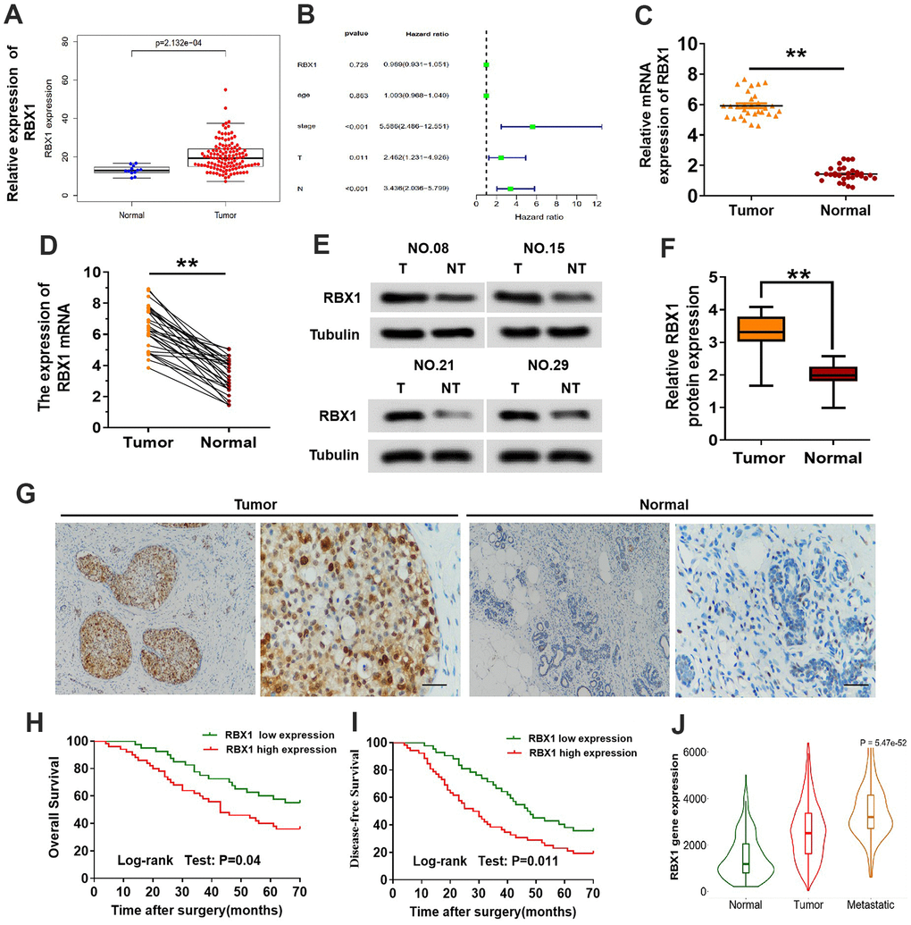 The expression of RBX1 was over-expressed in the metastatic TNBC and greatly related to poor outcomes of patients. (A) Expression of RBX1 mRNA in the dataset of TCGA TNBC cancer. (B) Correlation with the clinicopathological features and expression of RBX1 in patients with TNBC in TCGA cohort. (C, D) qRT-PCR was utilizing for analysing RBX1 mRNA expression levels in the tissues of TNBC tissues as well as their adjoining non-carcinoma normal tissues. *P**PE, F) Western blotting was applying for studying RBX1 protein expression levels in the tissues of TNBC tissues together with their adjoining non-carcinoma normal tissues. **PG) Immunohistochemistry was employed to identify The RBX1 protein expression existing in the tissues of TNBC and their neighboring non-carcinoma normal tissues. Scale bar, 50 μm. (H, I) For the overall survival (H) and the disease-free survival (I) in two groups of patients with TNBC, their Kaplan-Meier curves were defined by the low and high RBX1 expression, respectively. (J) In analysing the database of UALCAN, the expression of RBX1 was markedly elevated in metastatic and breast cancer tissues.