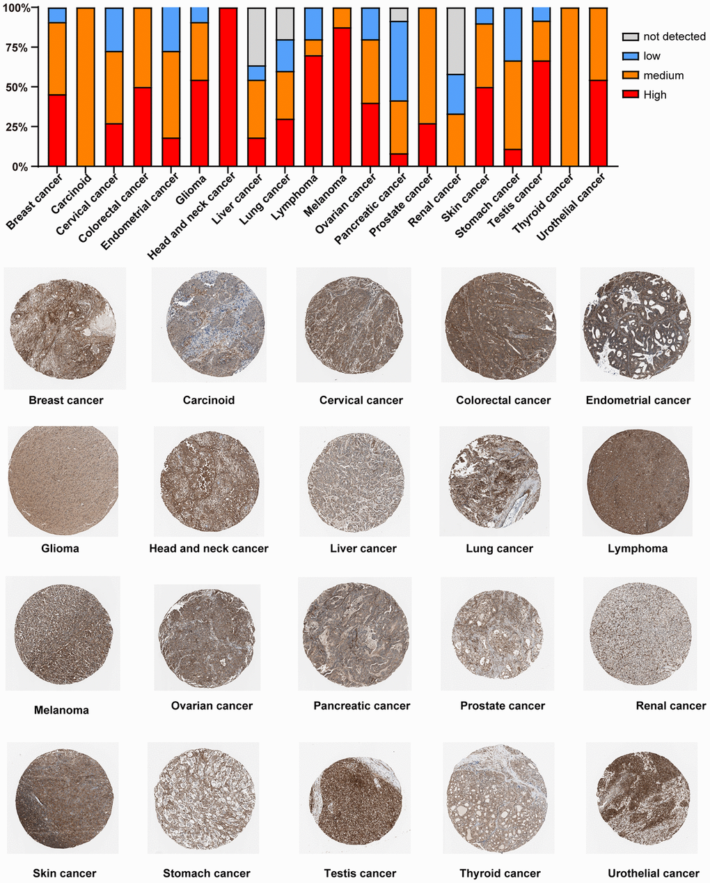 Immunohistochemical staining analysis of the PTPN11 protein in various TCGA tumor tissues via HPA database.