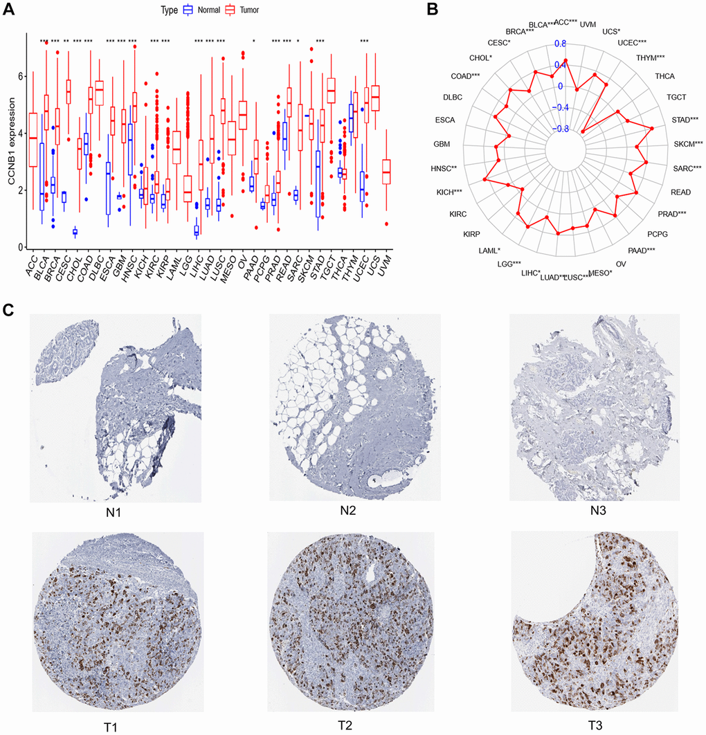 Expression of CCNB1 in normal breast tissue and tumor tissue. (A) Expression of CCNB1 in pan cancers. CCNB1 expression was shown to be higher in cancer tissues than in normal tissues in the TCGA study. (B) TMB of CCNB1 in pan cancer. A positive association with cancer is shown by a red dot bigger than 0; a negative correlation with cancer is indicated by a red dot less than 0. (C) The THPA website was used to examine the expression of the CCNB1 protein in BC specimens and noncancerous breast tissue. Three images of malignant and non-cancerous breast tissues were shown. Abbreviations: N: normal; T: tumor; TCGA: The Cancer Genome Atlas; THPA: The Human Protein Atlas; TMB: tumor mutation burden. *P **P ***P 