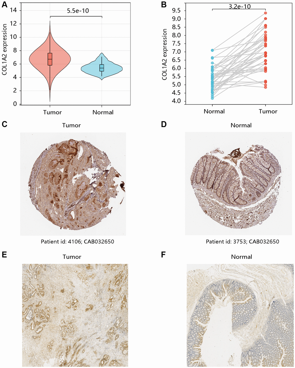 The mRNA and protein levels of COL1A2 in colon adenocarcinoma (COAD). The differential gene expression of COL1A2 in COAD and normal tissues using (A) unpaired and (B) paired t-tests. The COL1A2 protein levels in (C) COAD and (D) normal colon tissues using the HPA database. The COL1A2 proteins in (E) COAD and (F) normal colon tissues by the immunohistochemistry analysis.