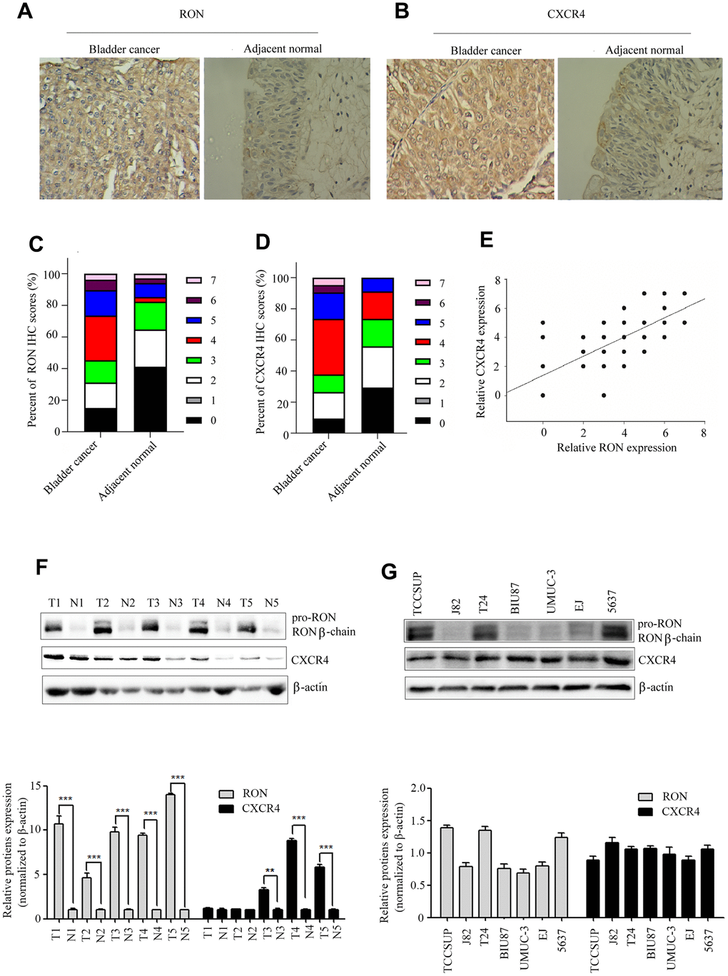 High expression of CXCR4 is correlated with RON in BC. Representative immunohistochemical staining for RON (A), and CXCR4 (B) protein expression in BC tumor and adjacent normal tissues. Average scores for RON (C), and CXCR4 (D) in BC tumor versus in adjacent normal tissues. The association with RON and CXCR4 expression in BC clinical samples was analyzed (E). RON and CXCR4 expression were detected by western blot in five representative BC tumor and corresponding adjacent non-tumor tissues (F), as well as in seven urothelial BC cells (G).