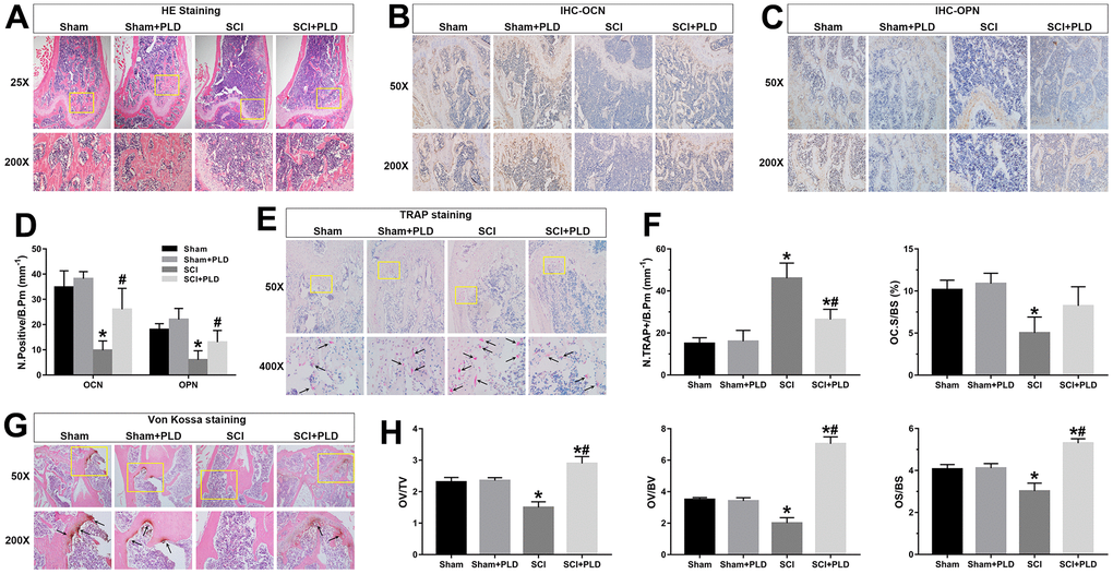 Effects of PLD on bone morphology, bone formation, calcium deposition and bone resorption. (A) Representative photomicrographs of H&E-stained sections. IHC analysis of (B) OCN and (C) OPN protein expression in distal femurs. (D) Number of OCN+ and OPN+ osteoblasts on the bone surface. (E) Representative images of TRAP-stained distal femoral sections. Arrows indicate TRAP+ cells. (F) Histo-morphometric quantification of osteoclast number per bone perimeter (N.TRAP+/B.Pm), and normal osteoclasts surface per bone surface (OC.S/BS). (G) Representative images of von Kossa-stained mouse femoral trabecular bone sections. Arrows indicate the presence of mineralized bone. (H) Quantitative analysis of osteoid volume versus total volume (OV/TV), osteoid volume versus bone volume (OV/BV), and osteoid surface versus bone surface (OS/BS). Measurements were presented as mean ± S.D.; n=6 to 7 per group; *P P 