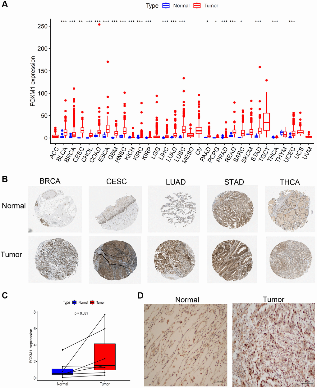 Expression levels of FOXM1 in pan-cancer. (A) Boxplot of the mRNA expression of FOXM1 in 31 types of solid tumor and normal tissues from TCGA database. (B) Representative IHC staining of FOXM1 in BRCA, CESC, LUAD, STAD and THCA normal and tumor tissues in HPA. (C) Expression of FOXM1 in tumor group were upregulated than that in normal group. (D) IHC analysis of FOXM1 in LUAD tissues. Representative images are shown. *p **p ***p 