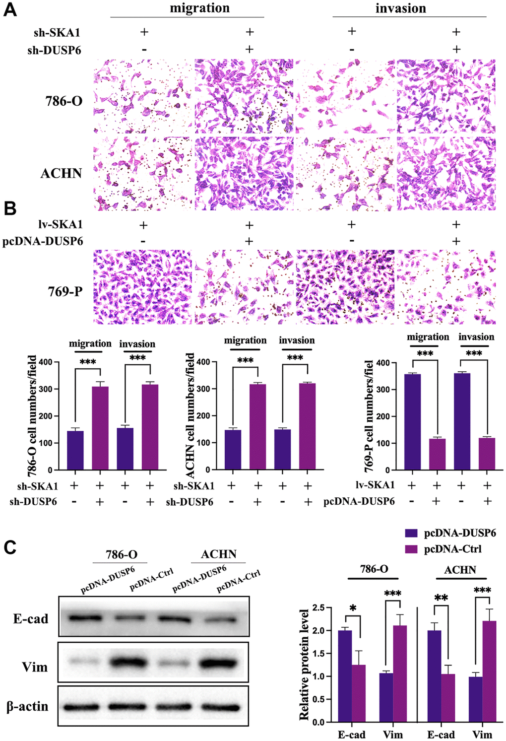 DUSP6 mediates SKA1 depletion-induced tumor suppression. (A and B), Transwell assay was used to assess the invasiveness and migration of cells transfected with indicated constructs. Data shown are mean from three independent experiments performed in triplicate. *P C) Western blot analysis of E-cadherin and vimentin protein levels in cells transfected with indicated constructs after TGF-β1 treatment. One representative experiment of three independent experiments are shown.