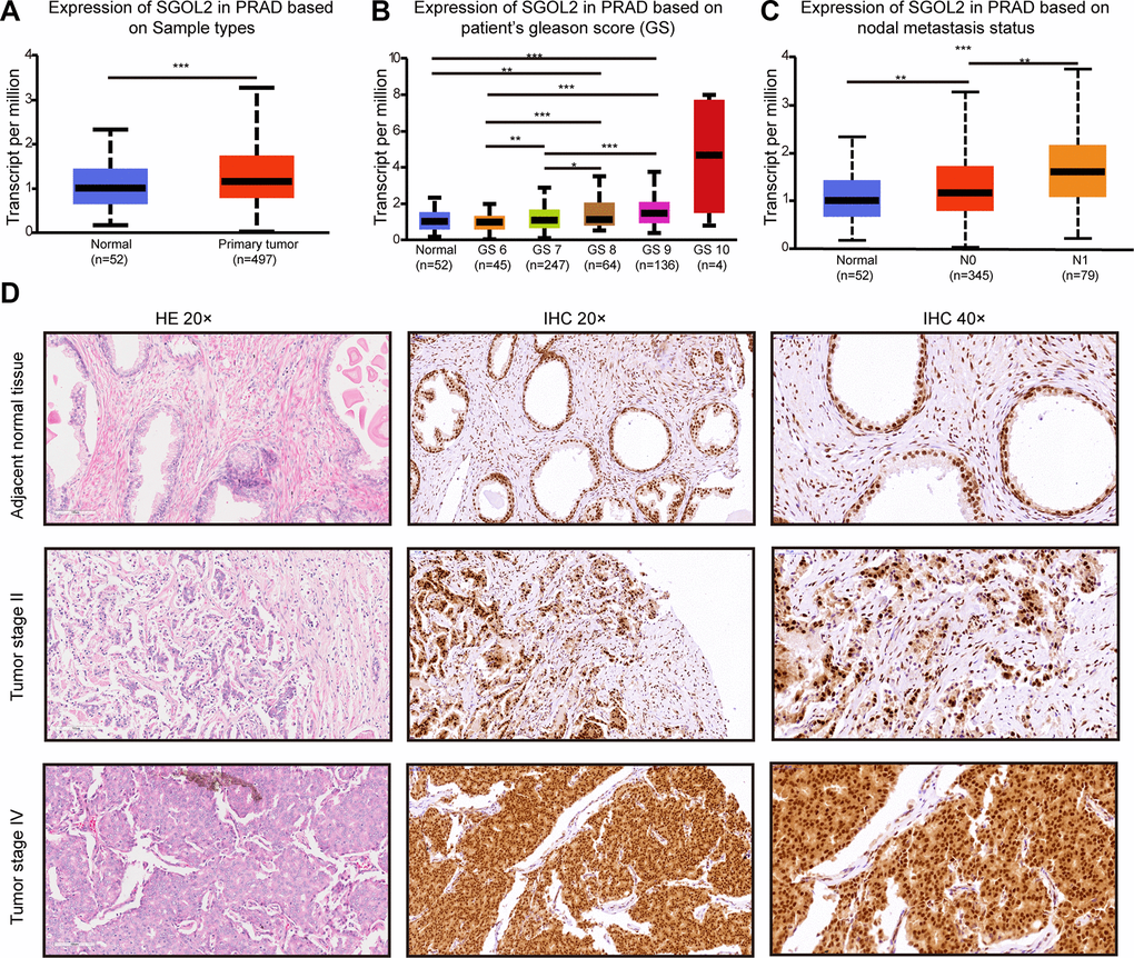 The levels of SGOL2 expression upregulated in prostate cancer. (A) TCGA analysis showed SGOL2 expression in prostate cancer tissue and adjacent normal tissue. (B) The relationship between SGOL2 expression and the Gleason score of patients. (C) Correlation between SGOL2 expression and nodal metastasis status. (D) Representative IHC images for SGOL2 expression level in prostate cancer tissue microarrays. *, P