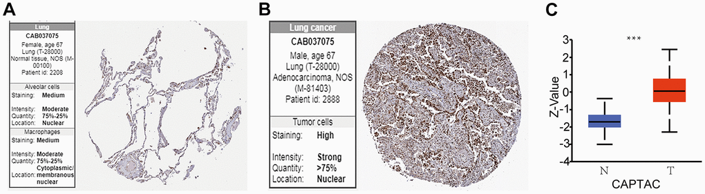 BUB3 protein expression levels in LUAD. (A, B) Protein expression of BUB3 in tumor and normal tissues; data obtained from the HPA. (C) Protein expression of BUB3 in LUAD and normal tissues; data obtained from the CAPTAC database (* p 