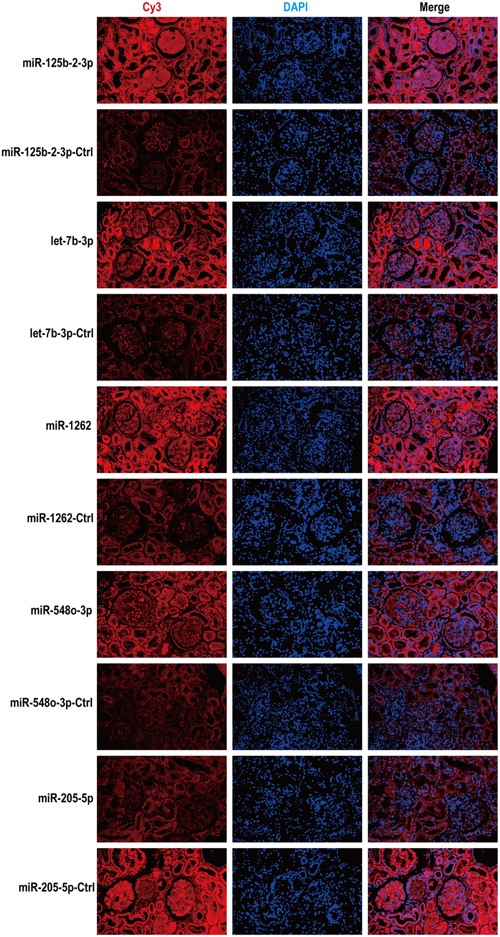 According to fluorescence in situ hybridization, all five miRNAs were expressed in renal tissues of MsPGN patients. Nuclei are stained blue (DAPI) and miRNAs are stained red. Magnification, x200.