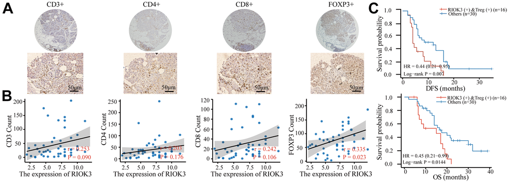 Patients with RIOK3 and Treg cell positivity have a worse prognosis. (A) Representative IHC staining of CD3, CD4, CD8, and FOXP3 in PDAC tissues (n=46). The cut-off value of immune cells was median. (B) The association between RIOK3 expression and the number of CD3, CD4, CD8, and FOXP3 cells in PDAC (|r|>0.2 and pC) Kaplan–Meier curves of DFS and OS analysis according to RIOK3 and Treg cell levels in PDAC patients (n=46, 16 RIOK3-high+Treg-high and 30 others).