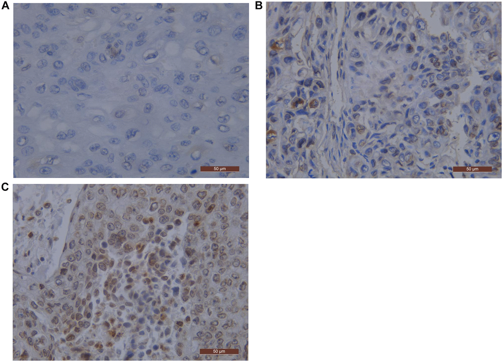 EGFR representative pictures by immunostaining in ESCC. Scale bar represents 50 μm. (A) Staining score 0 negative pattern for EGFR; (B) Staining score 2 negative pattern for EGFR; (C) Staining score 12 negative pattern for EGFR. Abbreviations: EGFR: Epidermal Growth Factor Receptor; ESCC: Esophageal Squamous Cell Carcinoma.