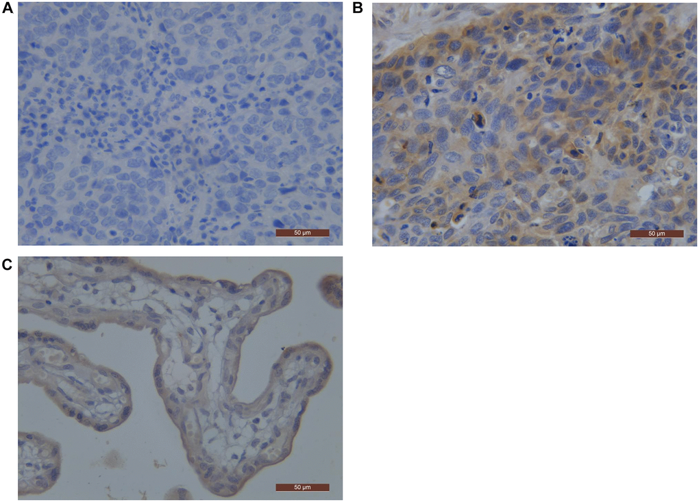 PD-L1 representative pictures by immunostaining in ESCC. (A) Negative pattern for PD-L1; (B) Positive pattern for PD-L1; (C) the positive control staining (Placental tissue). Abbreviations: ESCC: Esophageal Squamous Cell Carcinoma; PD-L1: Programmed Death-Ligand 1.