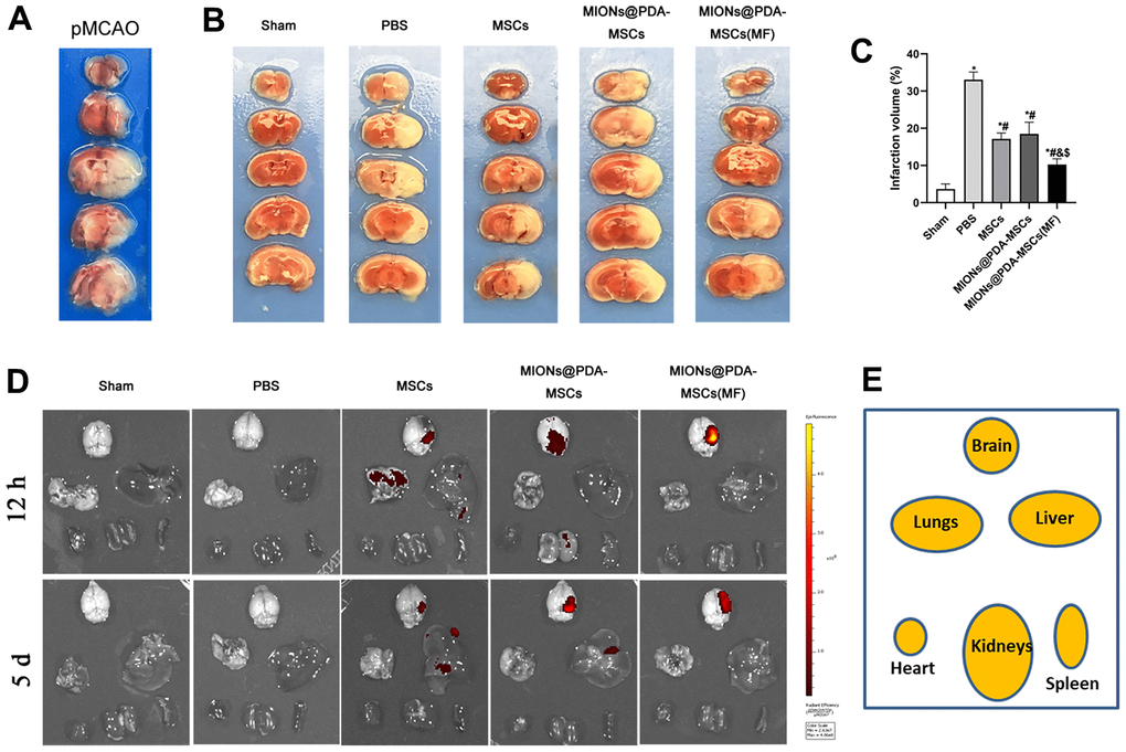 Effects of HUMSCs on infarct volume and behavioral improvement. (A) Representative brain slices with infarction volume shown by TTC staining. (B, C) HUMSCs treatment significantly reduced infarct volume. (D, E) Bio-distribution of the MSCs following their intravenous injection into the pMCAO-induced mice with or without the MF, evaluated by the IVIS imaging of major organs. Data are presented as the means ± standard deviation. HUMSC, human umbilical cord mesenchymal stem cell; MIONs@PDA-MSCs, HUMSCs labeled with polydopamine-capped Fe3O4 nanoparticles; MIONs@PDA-MSC(MF), MIONs@PDA-MSCs with external magnetic field; PBS, middle cerebral artery occlusion with phosphate-buffered saline administration; Sham, sham operation; TTC, 2,3,5-triphenyl-2H-tetrazoliuM chloride. *p #p &p $p 