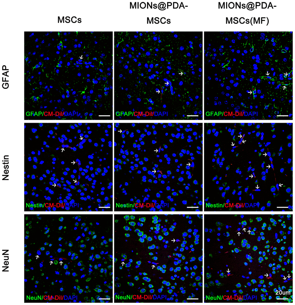 Human umbilical cord mesenchymal cells (HUMSCS) differentiate into neural cells. Immunofluorescence analysis showed no overlap between CM-Dil+HUMSCs and neurons (NeuN+), neurogliocyte (GFAP+), or neural stem cells (Nestin+). scale bars = 20 μm.