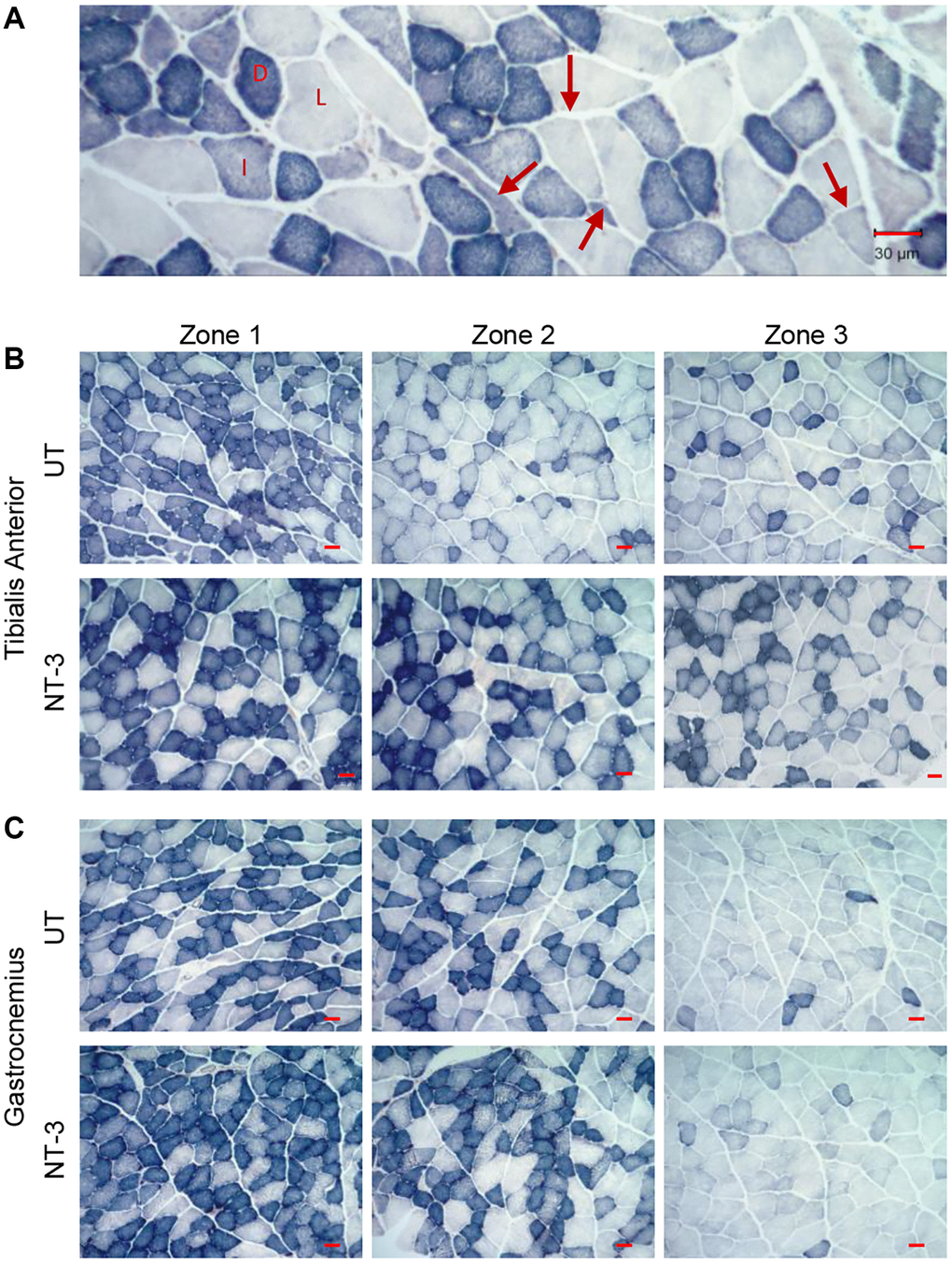 Muscle fiber size increase in aged C57BL/6 mice with AAV1.NT-3 gene therapy. (A) Succinic dehydrogenase (SDH)-stained skeletal muscle showing muscle fiber types based on mitochondria content and angular atrophic type 2 fibers (arrows). Dark (D) fibers are fatigue-resistant slow twitch oxidative (STO) or type1 fibers, intermediate (I)-stained fibers are fast twitch oxidative (FTO/type 2A) fibers, and light (L) fibers are fast twitch glycolytic (FTG/type 2B). Representative images from (B) tibialis anterior and (C) gastrocnemius muscles showing three different zones (deep, intermediate, and superficial; designated as Zone 1, 2, and 3) from the untreated (UT) and NT-3 treated cohorts. Scale bar = 30 μm.