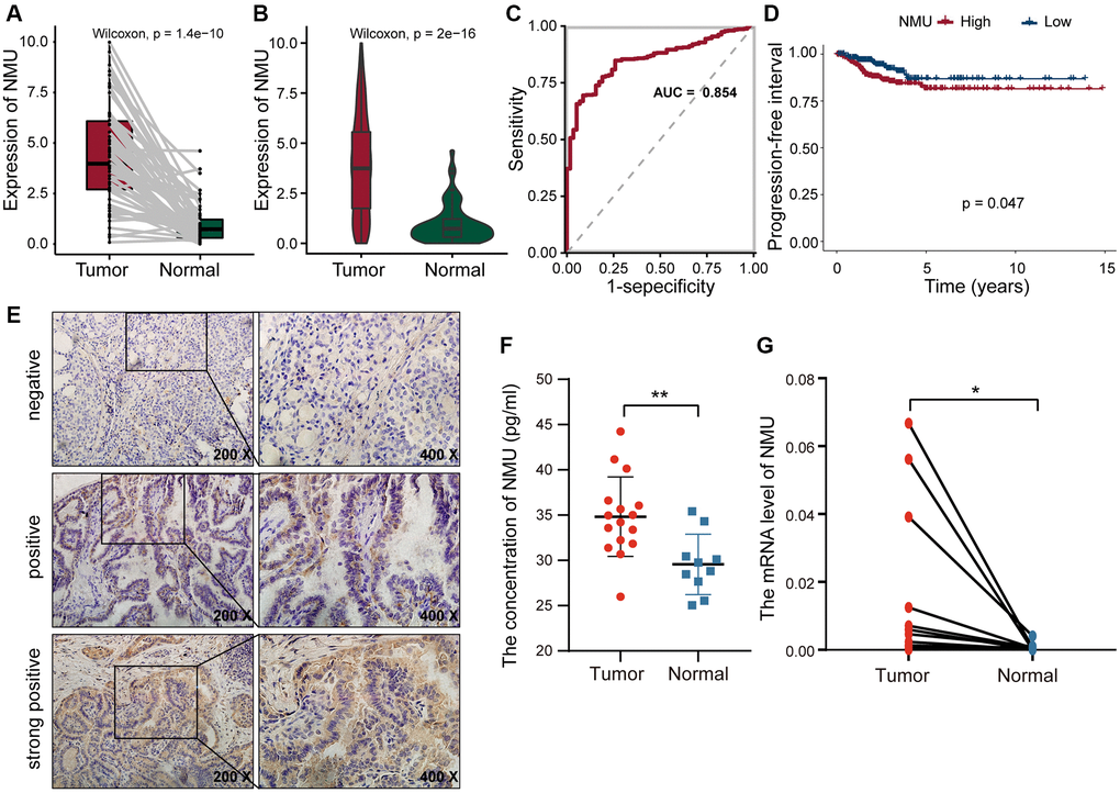 The differential expression of NMU in tumor and normal tissues. (A) Differential expression of NMU in tumor and normal tissues in the TCGA database (p = 1.4e-10). (B) Pair analysis of NMU expression between tumor and normal tissues from the same patient in the TCGA database (p = 2e-16). (C) The AUC of NMU expression was 0.854, obtained by a ROC curve analysis, distinguishing normal tissues from tumor tissues. (D) K-M analysis showed that patient prognosis was significantly worse when NMU expression was elevated (p = 0.047). (E) NMU was significantly overexpressed in tumor tissues, with a positive rate of 72% (18/25). (F) Serum NMU protein levels were significantly higher than in healthy individuals (**p G) RT-qPCR confirmed that NMU expression was significantly increased in tumor tissues (*p 